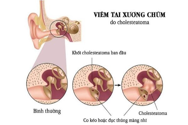 Viêm tai xương chũm là nguyên nhân gây chảy dịch tai